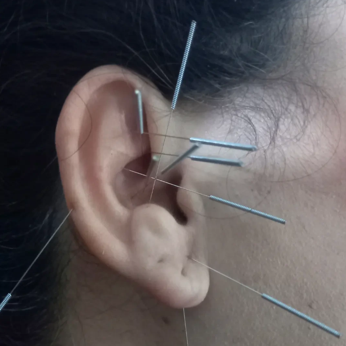 Procedimento de aplicação de agulhas para tratamento medicinal